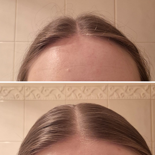Before and after comparison of a person's forehead with a tiled wall background.
