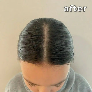 Person with treated hairline against a plain background, looking smoothe
